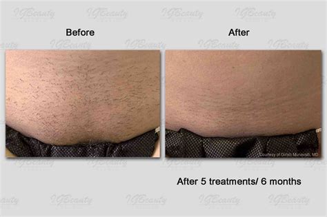laser hair removal brazilian review